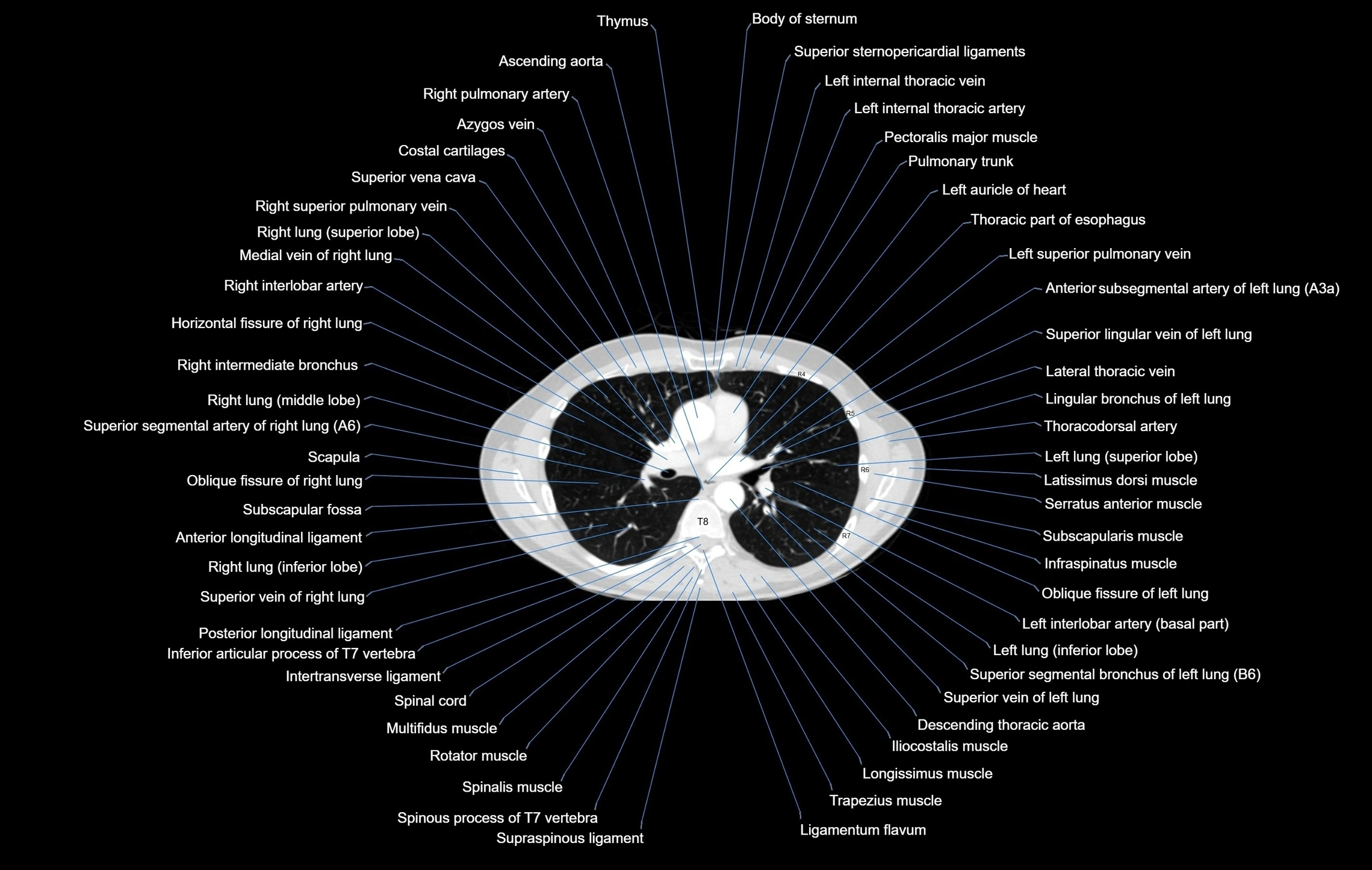 CT chest (thorax) labelled axial cross sectional anatomy radiology image-00059.webp